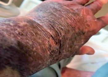 Batı Avustralya’da, AstraZeneca aşısından sonra korkunç durum