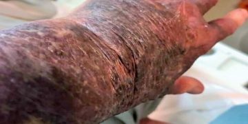 Batı Avustralya’da, AstraZeneca aşısından sonra korkunç durum