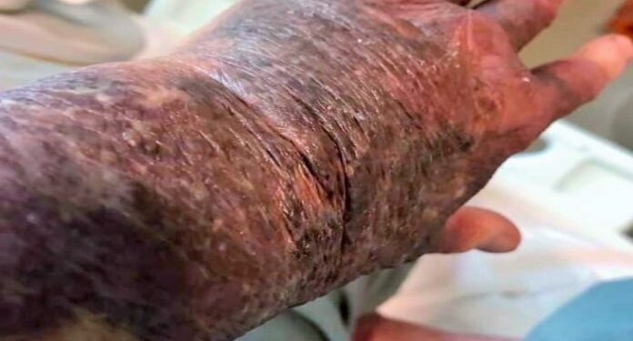 Batı Avustralya’da, AstraZeneca aşısından sonra korkunç durum