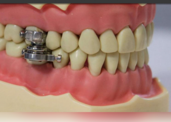 Yeni Zelandalı araştırmacılardan, kilo vermede ‘çene kilidi’ buluşu