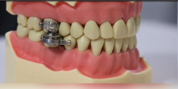 Yeni Zelandalı araştırmacılardan, kilo vermede ‘çene kilidi’ buluşu