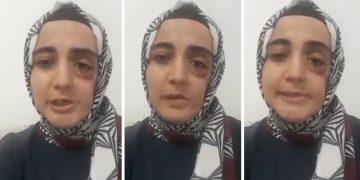 Ayşe Özdoğan’ın durumu kötüye gidiyor, yüzündeki platin yeniden çıkartılacak