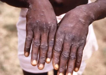 Maymun çiçeği yayılmaya devam ediyor: Türkiye’de ilk vaka görüldü